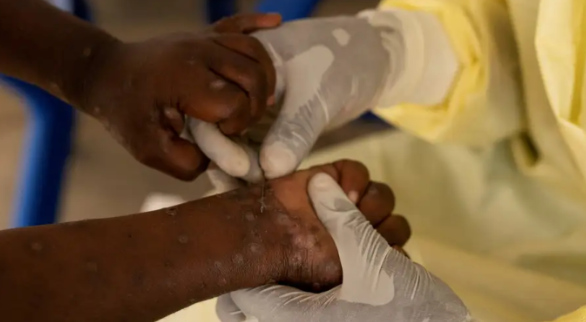 doenças infecciosas
